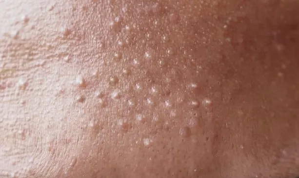 화이트 헤드(좁쌀 여드름)