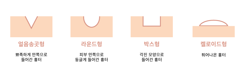 모공성 흉터 종류