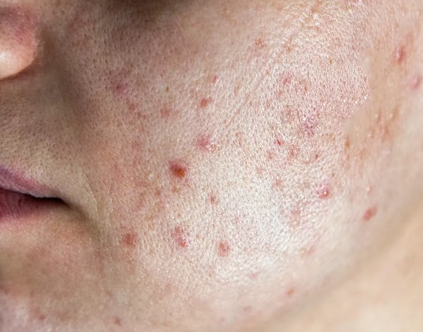 구진 붉은 여드름