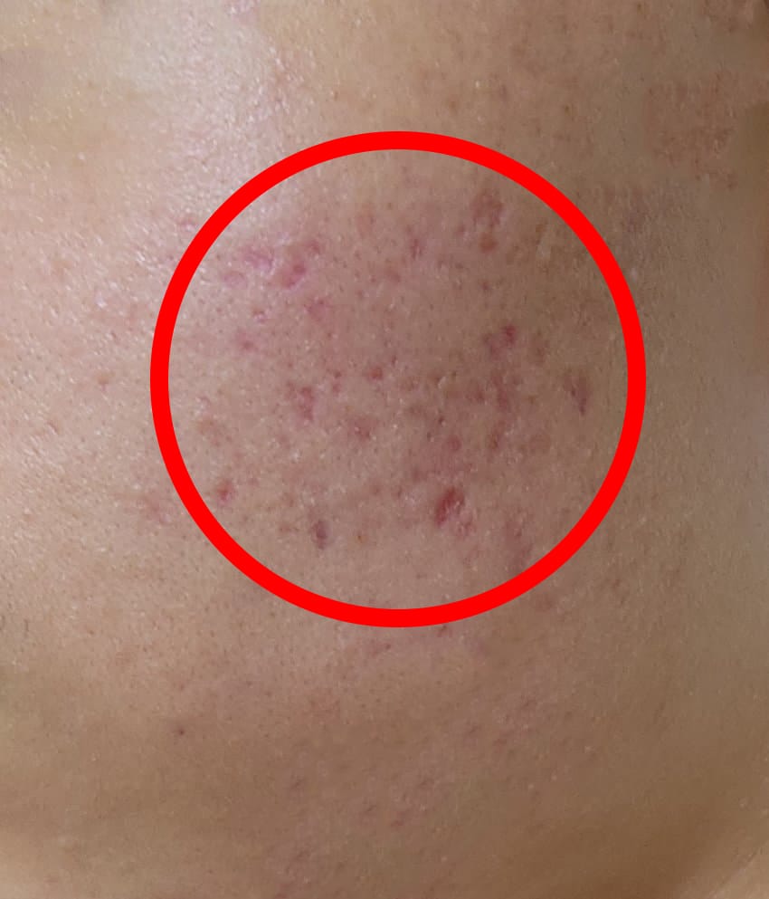 여드름 붉은자국