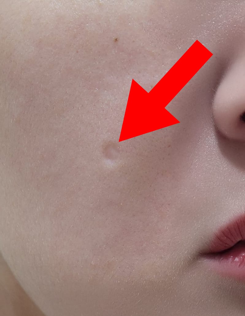 패인 흉터 자국