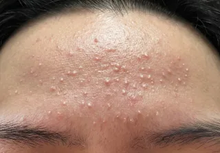 좁쌀 여드름 원인​과 없애는 법