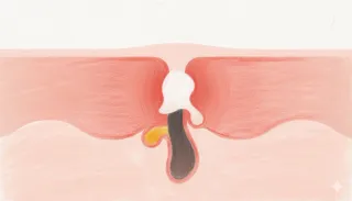 피부 트러블 종류 이 글만 보시면 됩니다